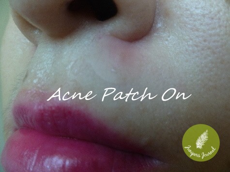 acne patch on