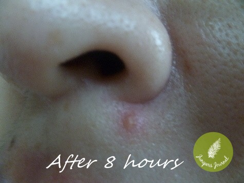 after acne patch
