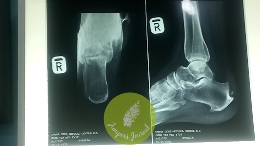 X-ray of right foot